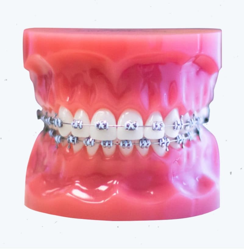 traditional metal braces on plastic model